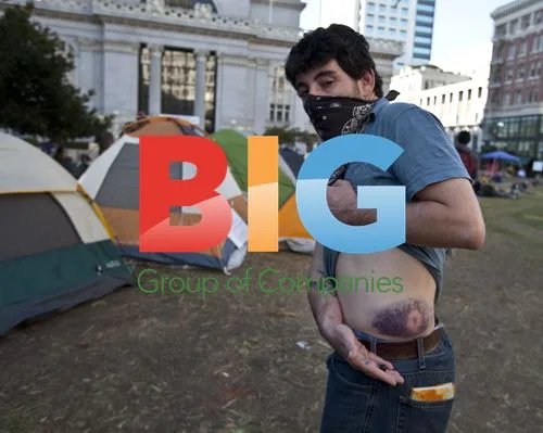 Occupy Oakland Protester Explains Rubber Bullet Injury