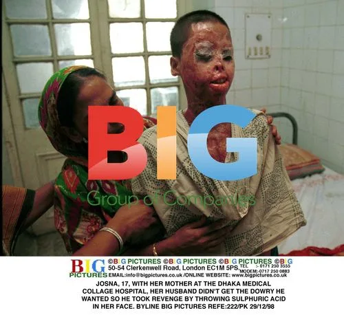 JOSNA, 17, ATTACKED WITH ACID