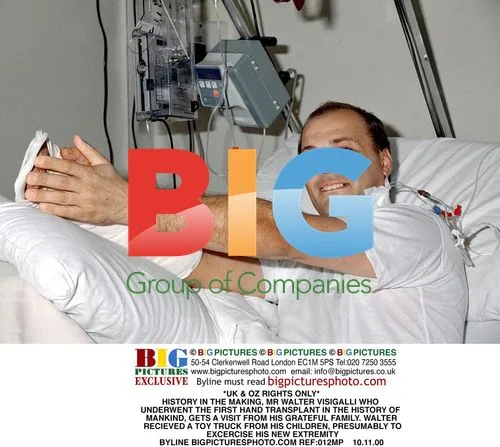 First Hand Transplant in History