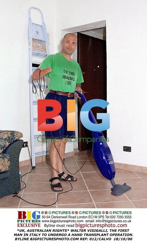 Walter Visigalli, first Italian hand transplant