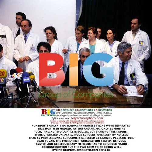 Moroccan Siamese Twins Separated in Madrid