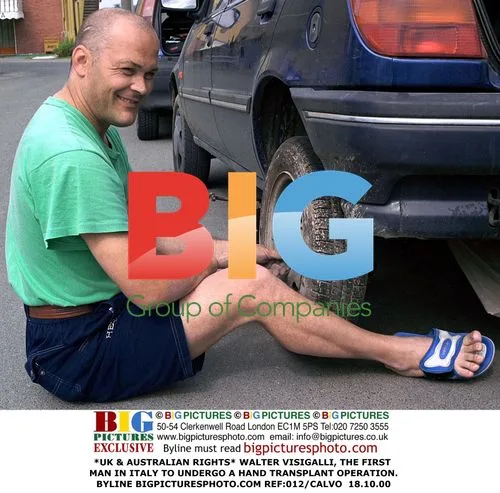 Walter Visigalli, First Italian Hand Transplant