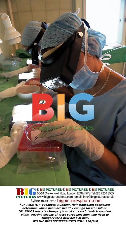Hair transplant in Budapest, Hungary