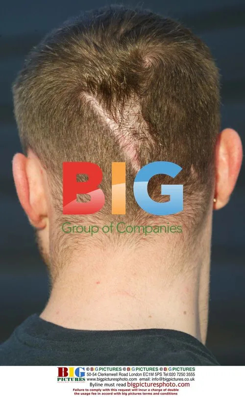 BRIAN HARVEY'S HEAD SCAR