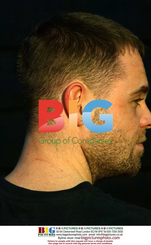 Brian Harvey's Head Scar Revealed