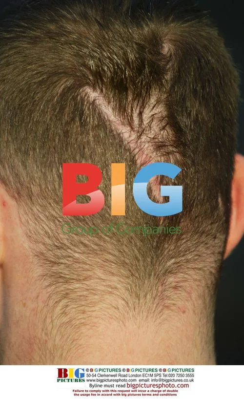 Brian Harvey's Head Scar