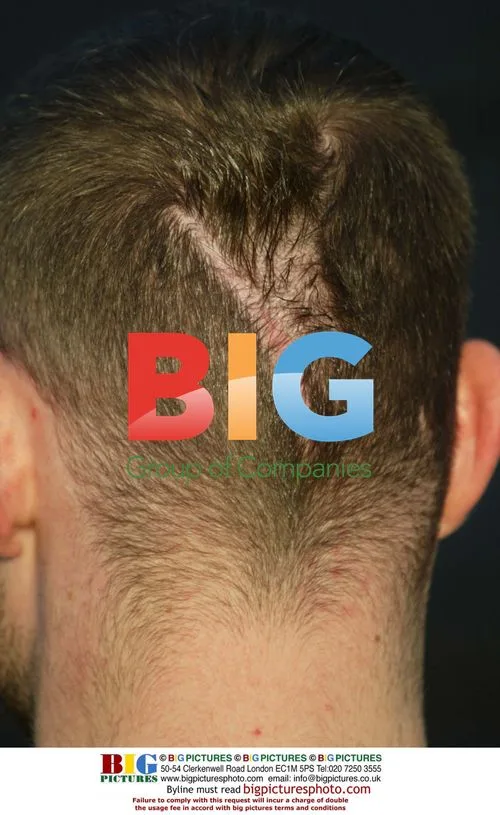 Brian Harvey's Head Scar