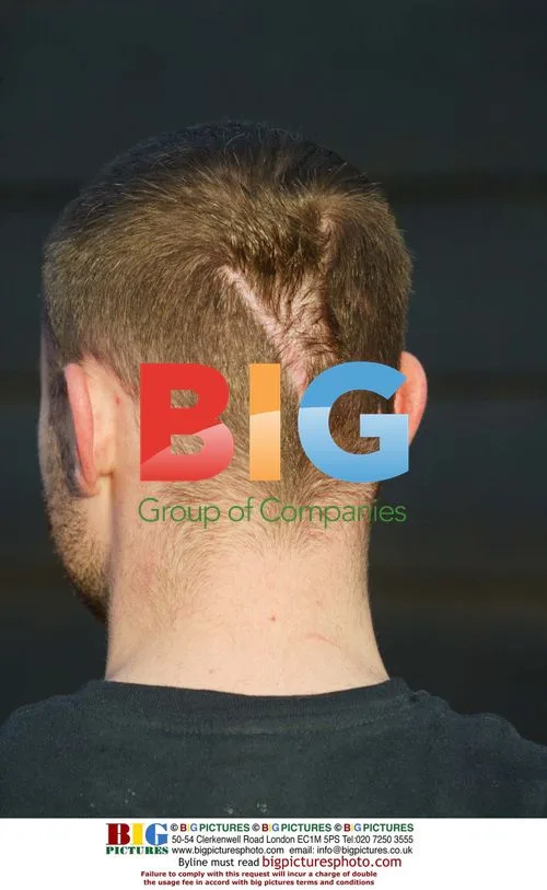 Brian Harvey's Head Scar