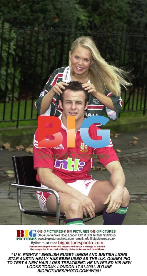 U.K. Rugby Star Tries New Hair Loss Treatment