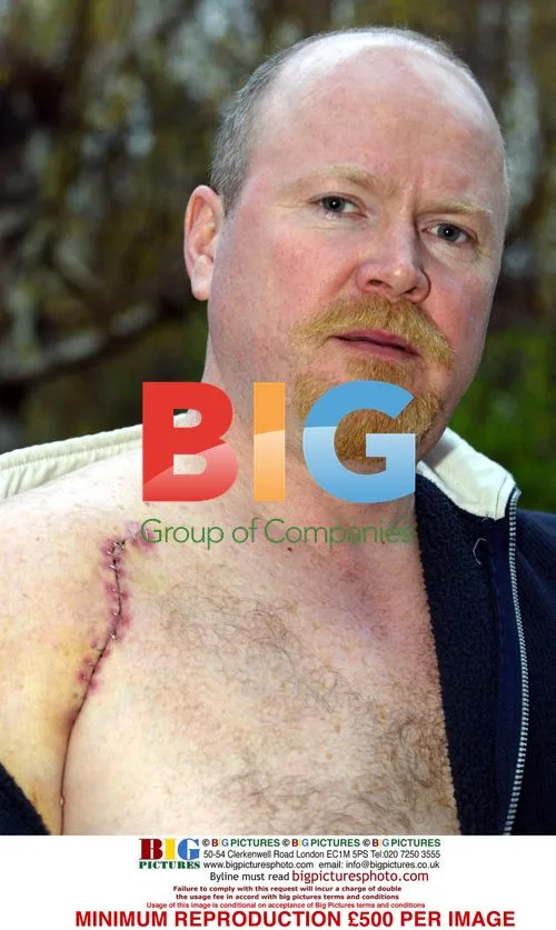 EastEnders' Steve McFadden's Injured Shoulder