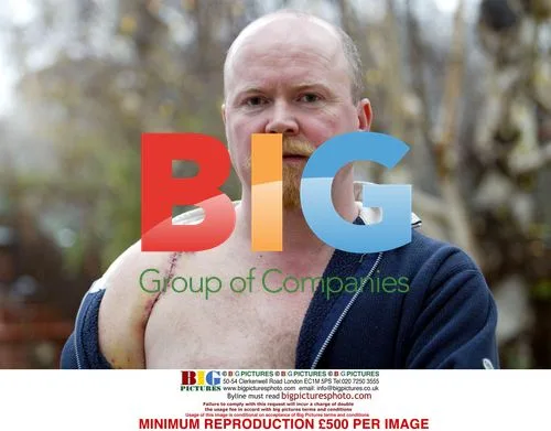 Steve McFadden's Injured Shoulder