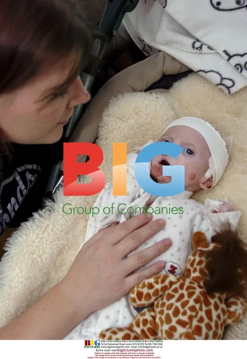 Tille, 6-Month-Old Suffering from Rare EB Disease