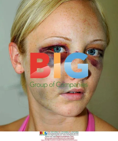 Victim of Vicious Assault at Surfers Hotel