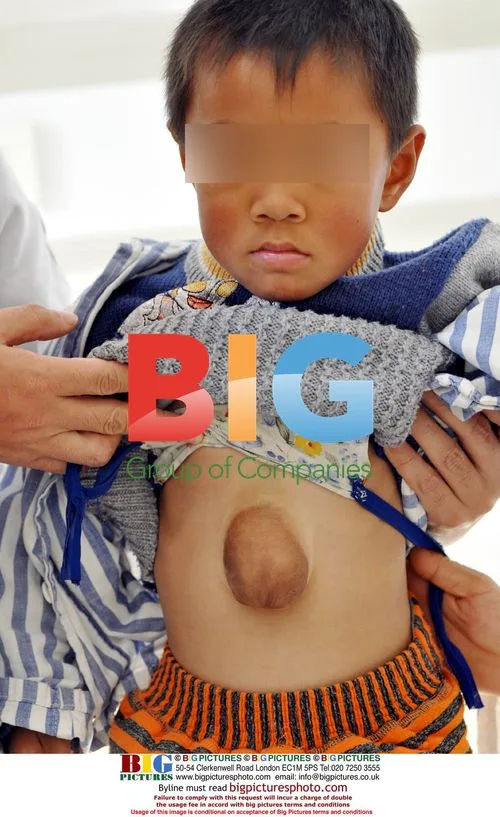 Chinese Boy Born with Protruding Heart