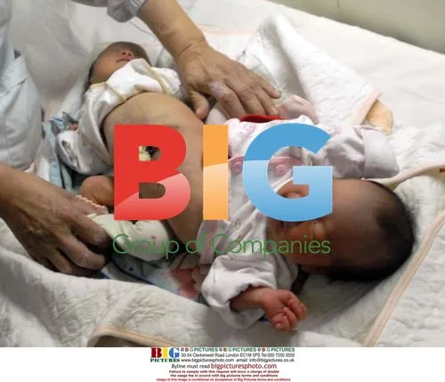 Cylindrical conjoined twins born in China